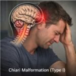 CHIARI MALFORMATION